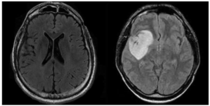 Healthy and Tumor Image